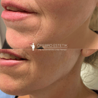 viscoderm hydrobooster örebro estetik